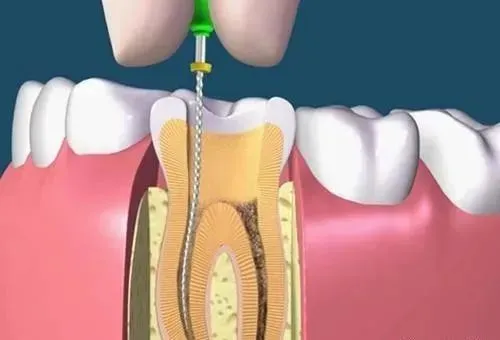 科普：做完根管治疗却没戴牙冠，现在后悔了！
